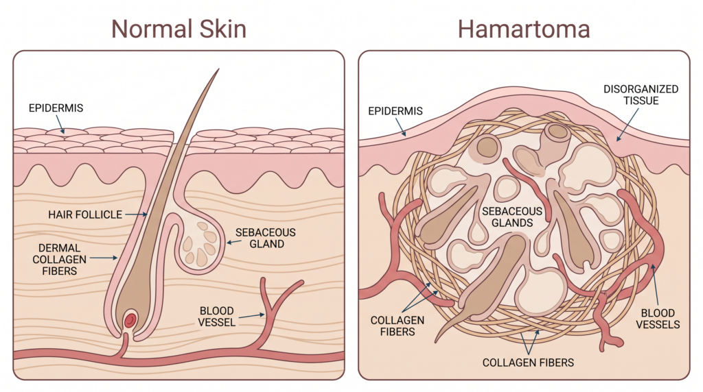 diagram normal skin vs hamartoma